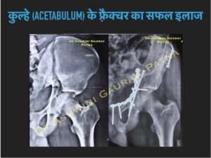 Acetabulum Fracture treatment