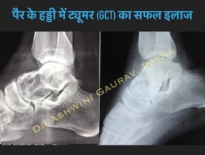 Leg bone tumor treatment