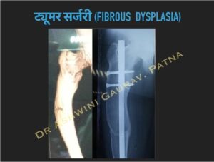 Fibrous Dysplasia