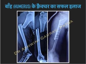 Humerus Fracture