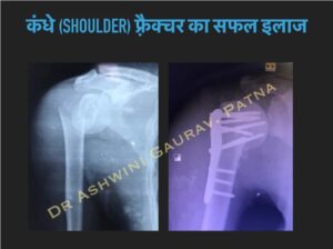 Shoulder Fracture