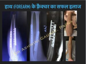 Forearm Fracture