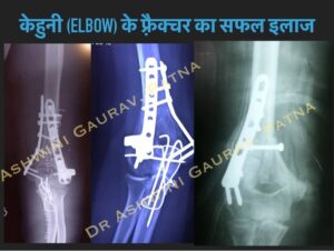 Elbow Fracture Treatment