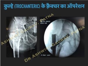 Hip Trochanteric Fracture Treatment