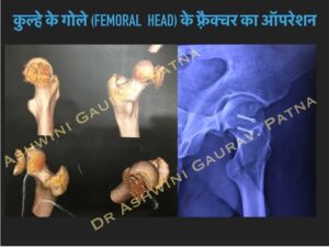 Hip Femoral Fracture surgery