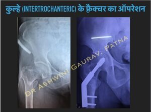 Hip Intertrochanteric Fracture Surgery