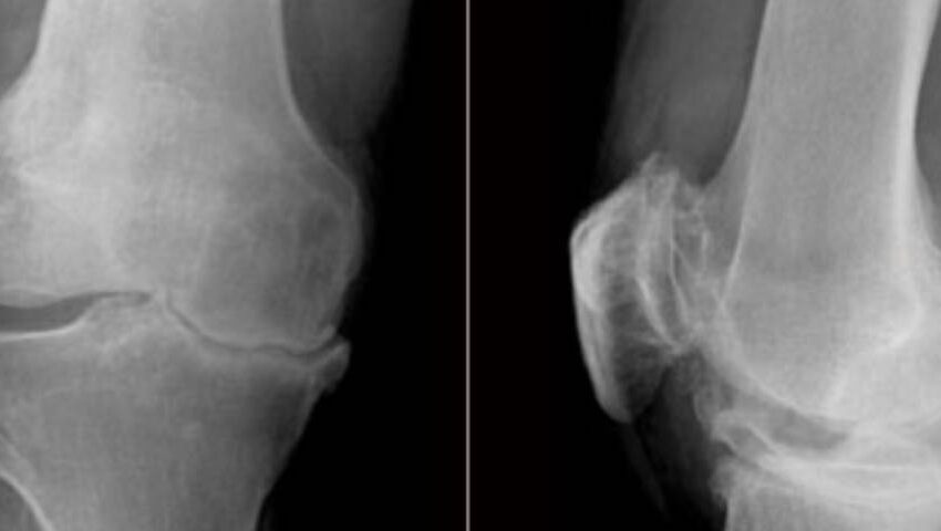 Osteoarthritis - Is it just a degenerative process? | Ortho Patna