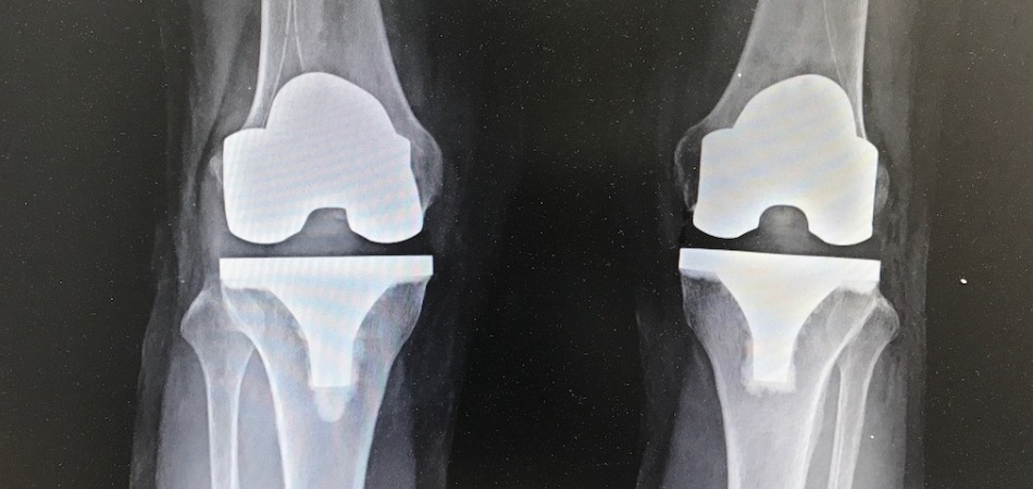 Total Knee replacement surgery in patna