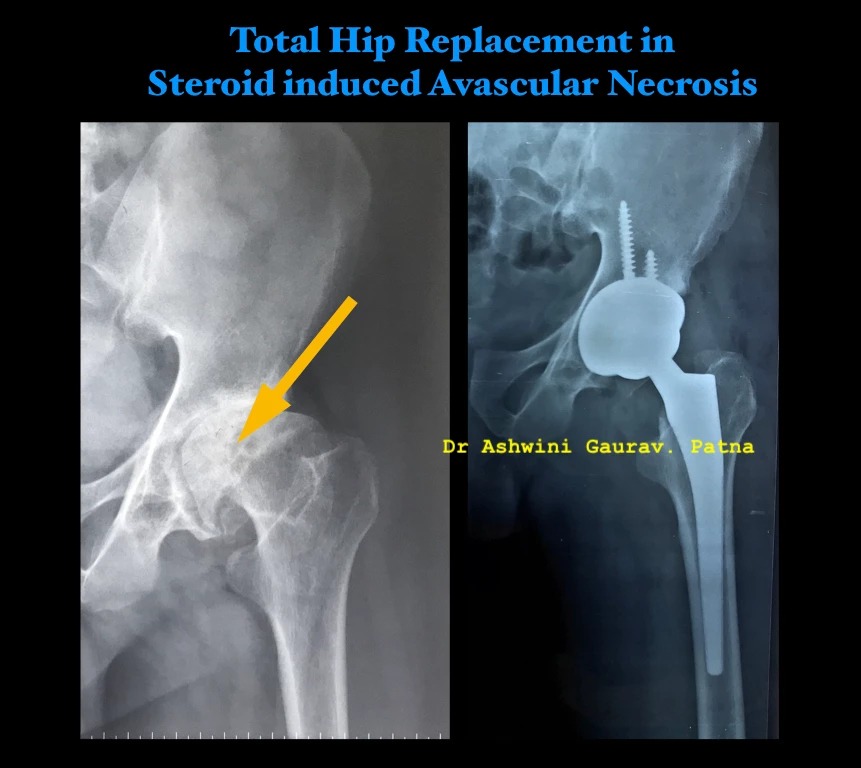 Total Hip Replacement in steriod
