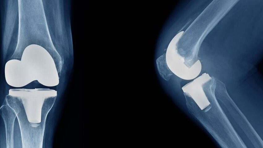 Knee Replacement Surgery FAQ