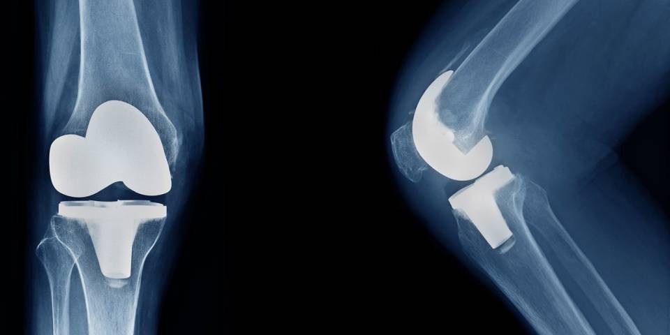 Knee Replacement Surgery FAQ