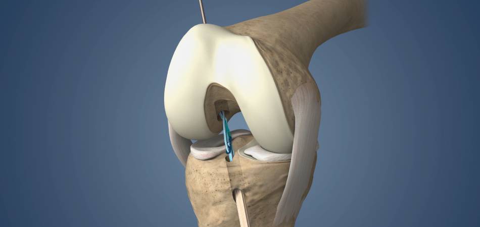 Best ACL Reconstruction surgeon in Patna