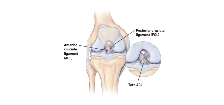 Symptoms of ACL Injury