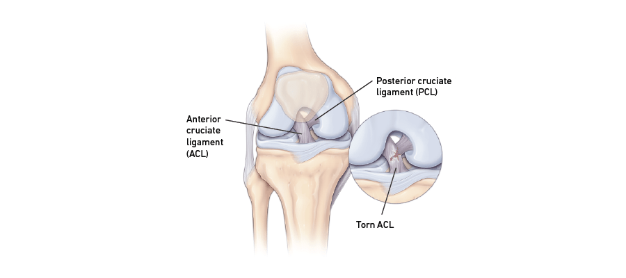 Symptoms of ACL Injury