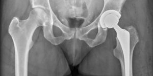 Hip Precautions After Hip Replacement Surgery | Hip Replacement