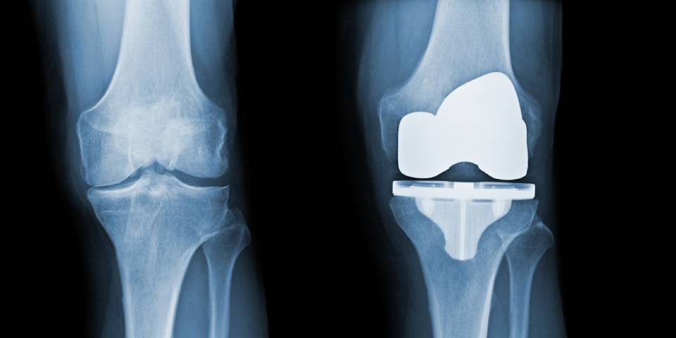 How long will Knee Replacement Last