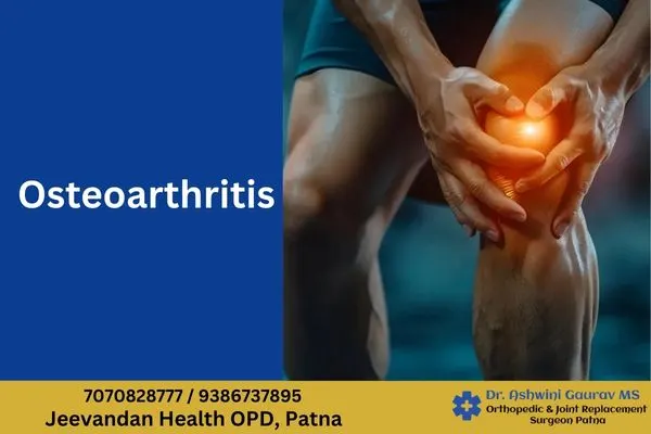 Osteoarthritis knee pain with joint inflammation treated by Dr Ashwini Gaurav orthopedic doctor in Patna