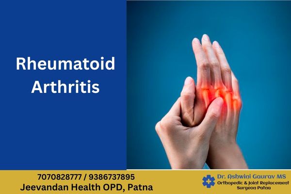 Rheumatoid arthritis autoimmune disease affecting small finger and toe joints treated by Dr Ashwini Gaurav in Patna