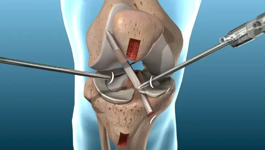 Arthroscopic ACL ligament reconstruction surgery illustration showing graft fixation in the knee joint.