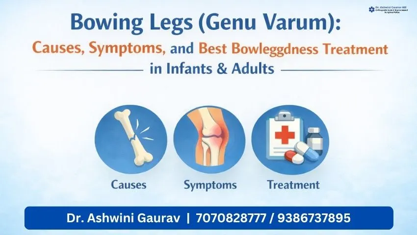 Bowing Legs Genu Varum treatment in Patna by Dr Ashwini Gaurav