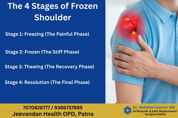 The 4 stages of frozen shoulder – freezing, frozen shoulder frozen stage, thawing and resolution phase explained by Dr. Ashwini Gaurav for shoulder frozen treatment in Patna