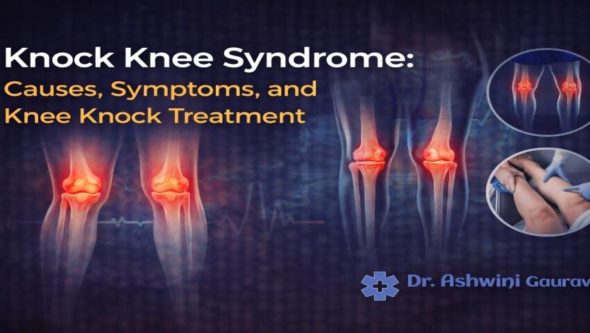 Knock knee syndrome showing knee alignment issue caused by bone deformity and joint imbalance – explained by Dr. Ashwini Gaurav