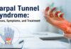 Diagram of Carpal Tunnel Syndrome showing median nerve compression in the wrist